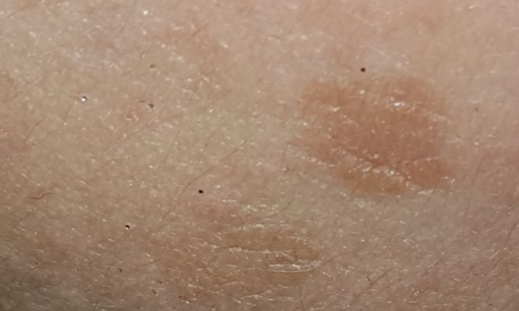 Melasma e macchie scure - 65509