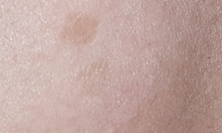 Melasma e macchie scure - 65510