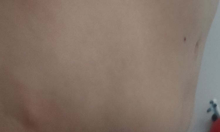 Gonfiori post addominoplastica - 66606