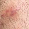 Imbibizione edematosa sotto cicatrice