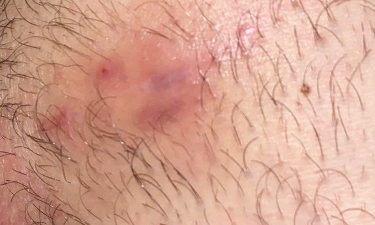 Imbibizione edematosa sotto cicatrice - 66733