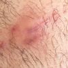Imbibizione edematosa sotto cicatrice