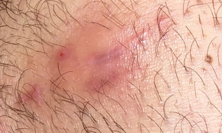 Imbibizione edematosa sotto cicatrice - 66734