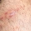 Imbibizione edematosa sotto cicatrice