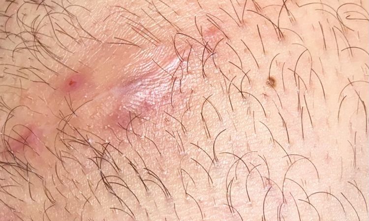 Imbibizione edematosa sotto cicatrice - 66735