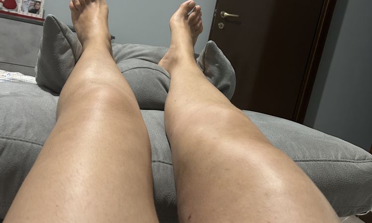 Bozzo sulla coscia, cosa può essere - 66902