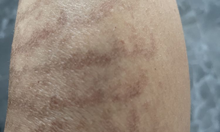 Ustione post gentle laser - 66972