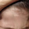 Cicatrice ipocromica viso bambino