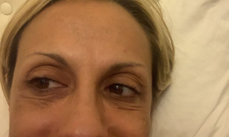 Fatto filler occhiaie più botox zampe di gallina Dolore!!! - 67339