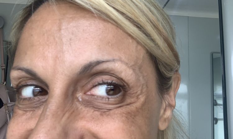 Fatto filler occhiaie più botox zampe di gallina Dolore!!! - 67340