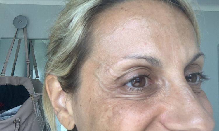 Fatto filler occhiaie più botox zampe di gallina Dolore!!! - 67343