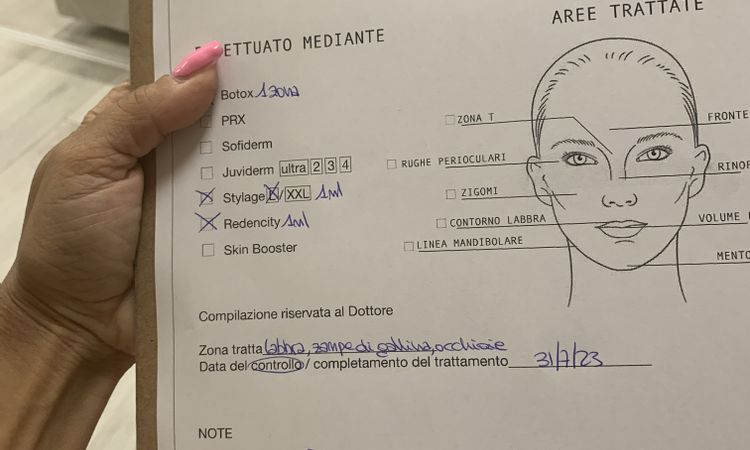 Fatto filler occhiaie più botox zampe di gallina Dolore!!! - 67345