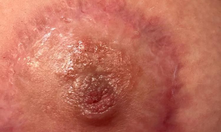 Areola infiammazione post mastopessi - 67407