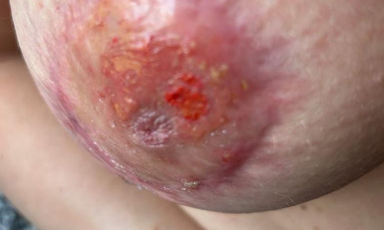 Areola infiammazione post mastopessi - 67408