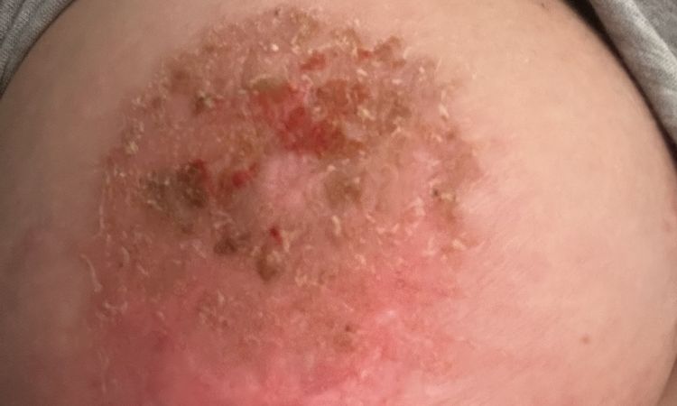 Areola infiammazione post mastopessi - 67409