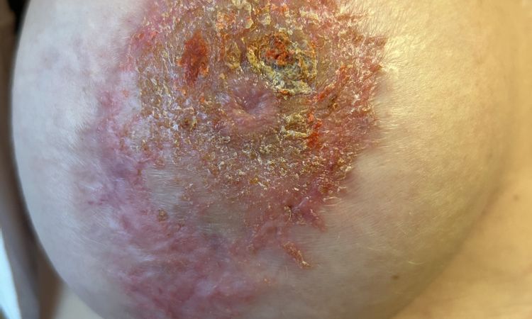 Areola infiammazione post mastopessi - 67410