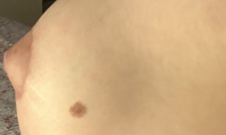 Areole gonfie post mastoplastica seno tuberoso - 67585