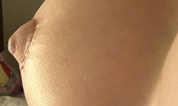 Areole gonfie post mastoplastica seno tuberoso - 67586