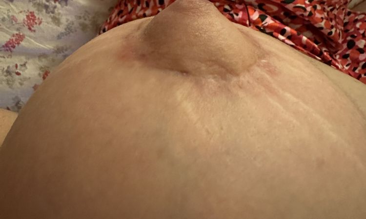 Areole gonfie post mastoplastica seno tuberoso - 67587