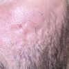 Cicatrici acne soluzione - 68175