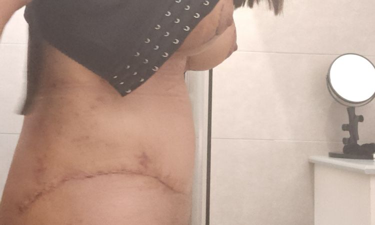 Sospetto sieroma dopo addominoplastica. - 68404