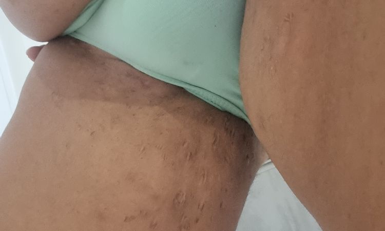addominoplastica e liposuzione combo - 68455