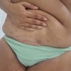 addominoplastica e liposuzione combo