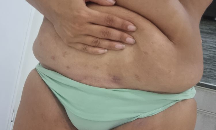 addominoplastica e liposuzione combo - 68456