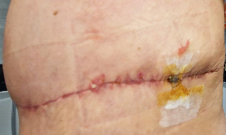 Punti sutura mastopessi e addominoplastica - 68603