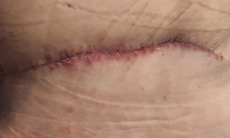 Punti sutura mastopessi e addominoplastica - 68604