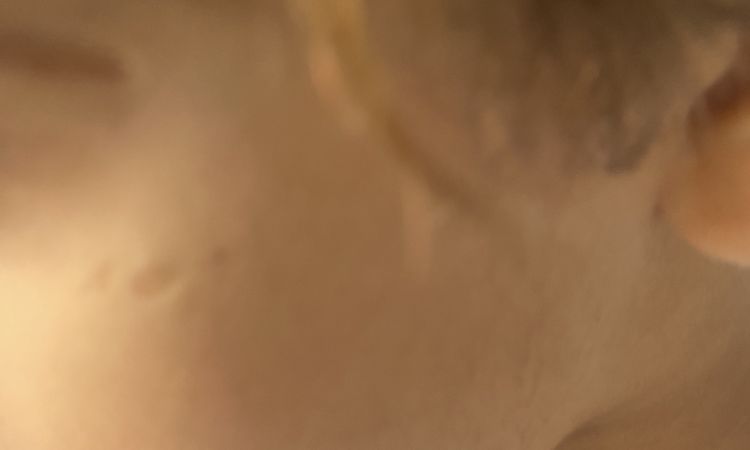 Cicatrici viso leggermente larga in un bambino di 5 anni - 68690