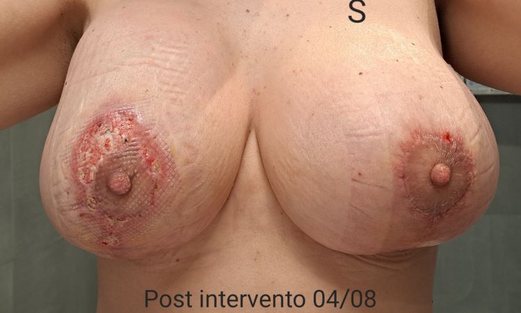 Seconda mastopessi dopo contrattura protesi - 68700