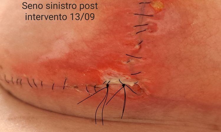Seconda mastopessi dopo contrattura protesi - 68704