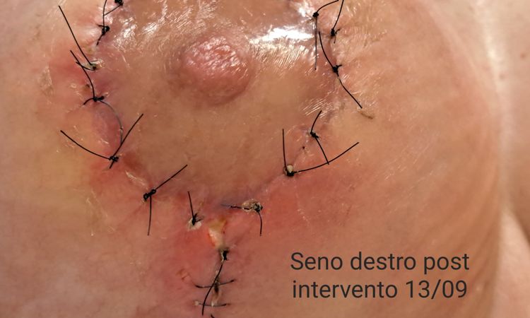 Seconda mastopessi dopo contrattura protesi - 68705