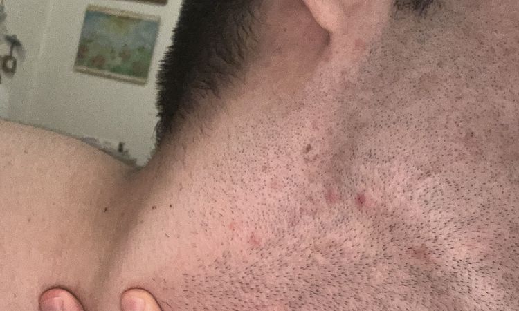 Acne da 15 anni diventato problema psicologico - 69013