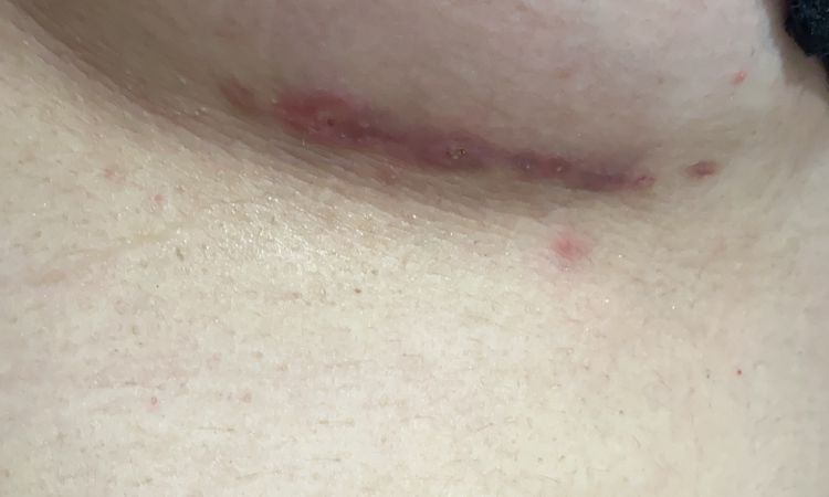 Cicatrice mastoplastica pus? - 69174