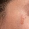 Rigonfiamento e formazione di cicatrice dopo dermoabrasione e peeling viso - 69283