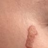 Rigonfiamento e formazione di cicatrice dopo dermoabrasione e peeling viso