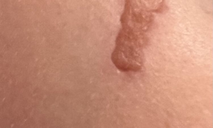 Rigonfiamento e formazione di cicatrice dopo dermoabrasione e peeling viso - 69284