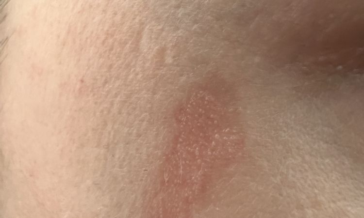Rigonfiamento e formazione di cicatrice dopo dermoabrasione e peeling viso - 69286