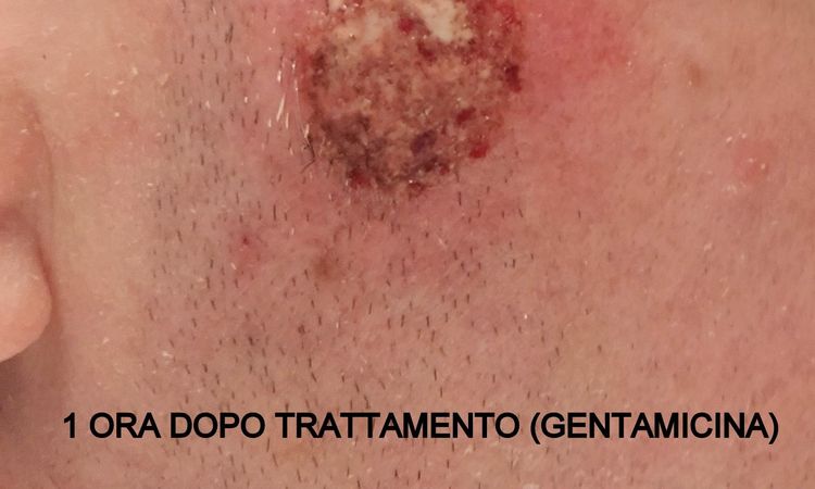 Cheratosi seborroica con laser CO2. Post-intervento? - 69480