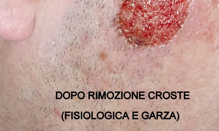 Cheratosi seborroica con laser CO2. Post-intervento? - 69481