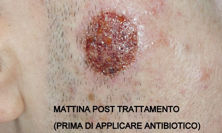 Cheratosi seborroica con laser CO2. Post-intervento? - 69482