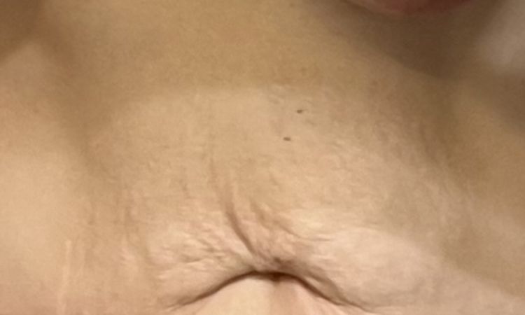 Intervento mommy makeover andato male - 69607