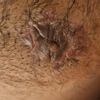 Ginecomastia falsa e round block