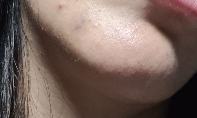 Filler al viso e possibilità pungere un nervo - 69810