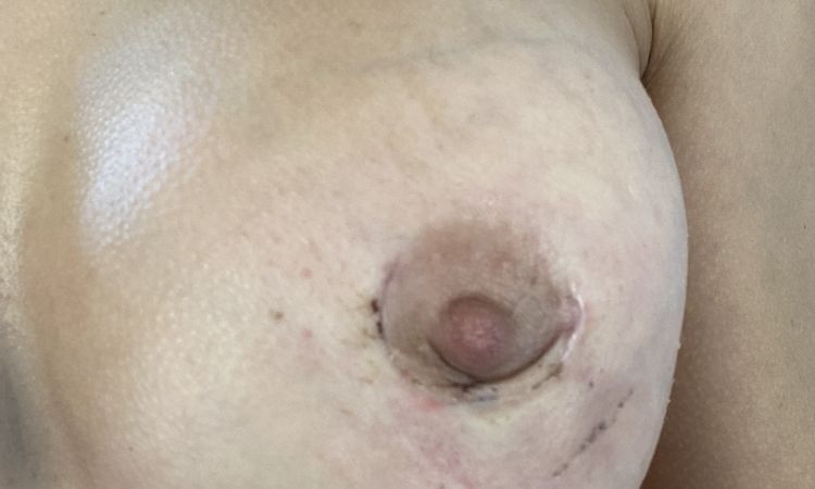 Cicatrice periareolare piega - 70522