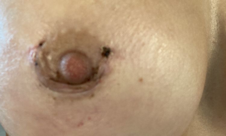 Cicatrice periareolare piega - 70523