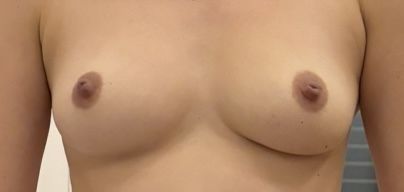 Mastoplastica additiva guarigione differenti o asimmetria - 70662