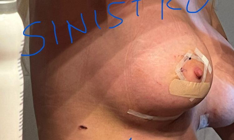 Si può alzare la protesi con fascia? - 70664
